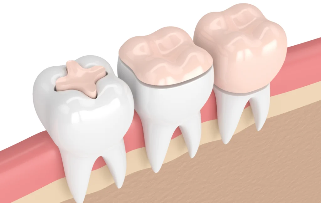 dentisterie restauratrice eora Inlay / Onlay Cabinet dentaire EORA