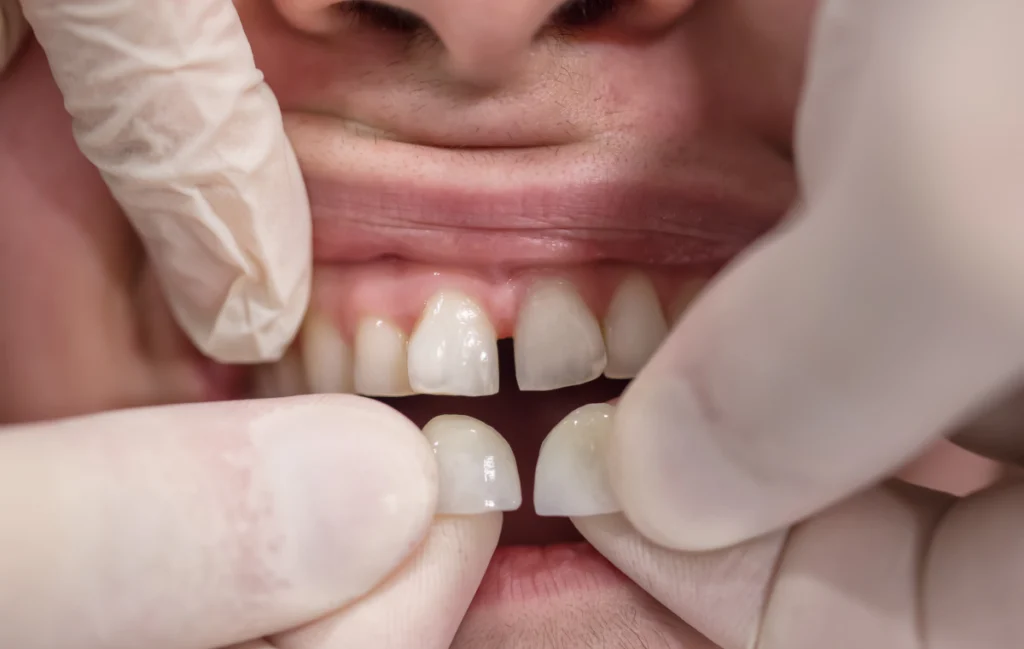 implant dentaire chirurgien dentiste Le secret d’un sourire parfait : les facettes dentaires Cabinet dentaire EORA