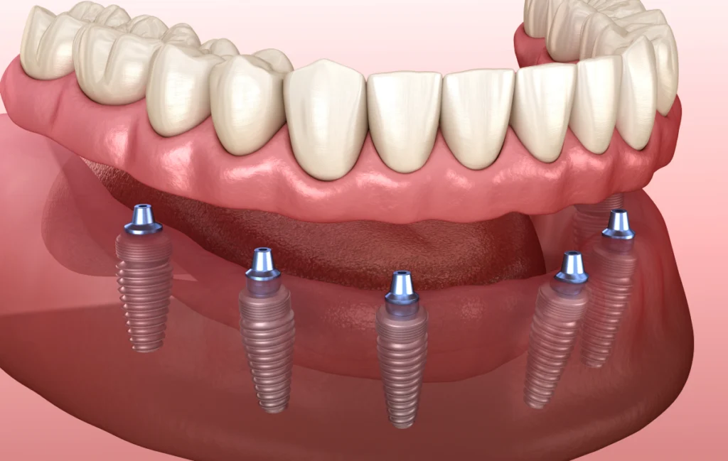 chirurgien dentiste blanchiment eora Restauration complète Cabinet dentaire EORA