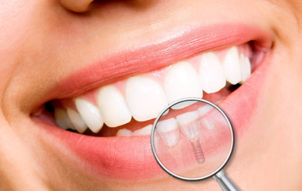 chirurgien dentiste blanchiment montagny Pose d'un implant dentaire Cabinet dentaire EORA