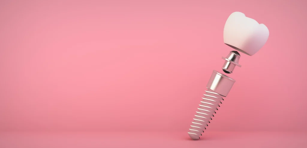 implant montyngy Pose d'un implant dentaire Cabinet dentaire EORA